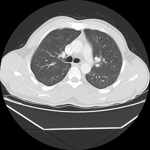 File:Aneurysmal bone cyst - rib (Radiopaedia 82167-96220 Axial lung window 28).jpg