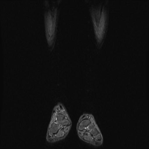 File:Aneurysmal bone cyst - tibia (Radiopaedia 22343-22367 Coronal STIR 2).jpg