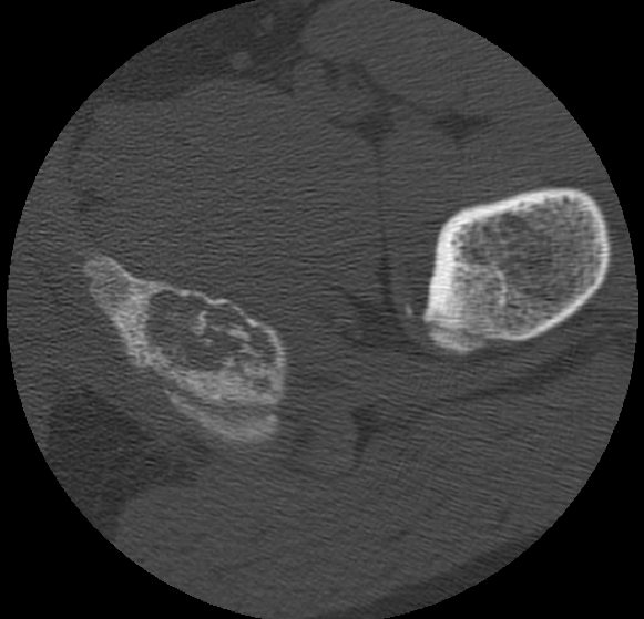 File:Aneurysmal bone cyst of ischium (Radiopaedia 25957-26094 B 50).png