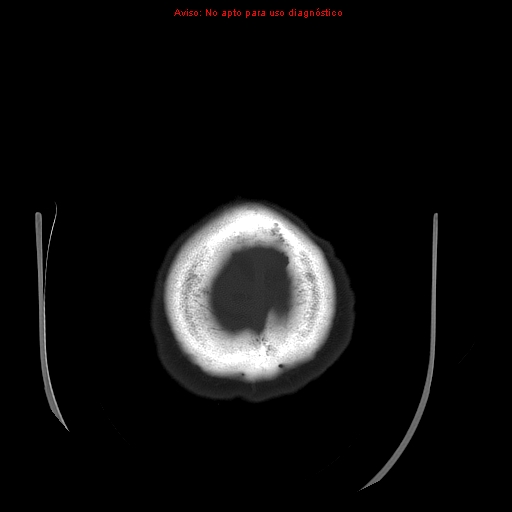File:Aneurysmal subarachnoid hemorrhage (Radiopaedia 24740-24997 bone window 34).jpg