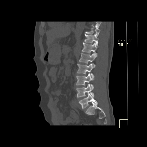 File:Ankylosing spondylitis (Radiopaedia 52728-58645 Sagittal bone window 5).jpg