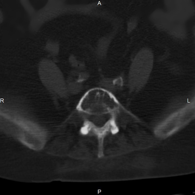 Ankylosing spondylitis (Radiopaedia 8748-9556 Axial bone window 45).jpg