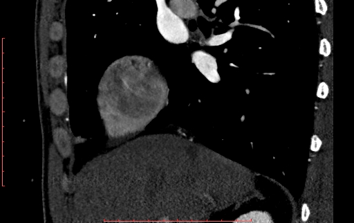 File:Anomalous left coronary artery from the pulmonary artery (ALCAPA) (Radiopaedia 70148-80181 C 16).jpg