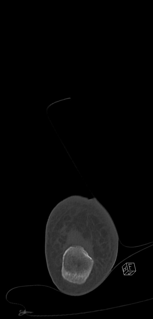 Anterior calcaneal process fracture (Radiopaedia 63353-71943 Coronal bone window 51).jpg