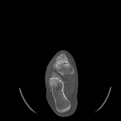 File:Anterior calcaneal process fracture (Radiopaedia 82590-96762 Axial bone window 24).jpg
