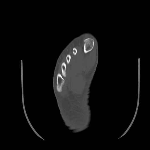 Anterior calcaneal process fracture (Radiopaedia 82590-96762 Axial bone window 37).jpg