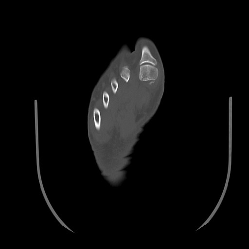 Anterior calcaneal process fracture (Radiopaedia 82590-96762 Axial bone window 40).jpg