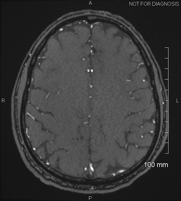 Anterior cerebral artery aneurysm (Radiopaedia 80683-94127 Axial MRA 183).jpg