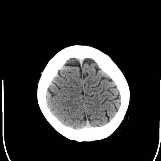 File:Anterior cerebral artery territory infarct (Radiopaedia 39327-41581 Axial non-contrast 25).png