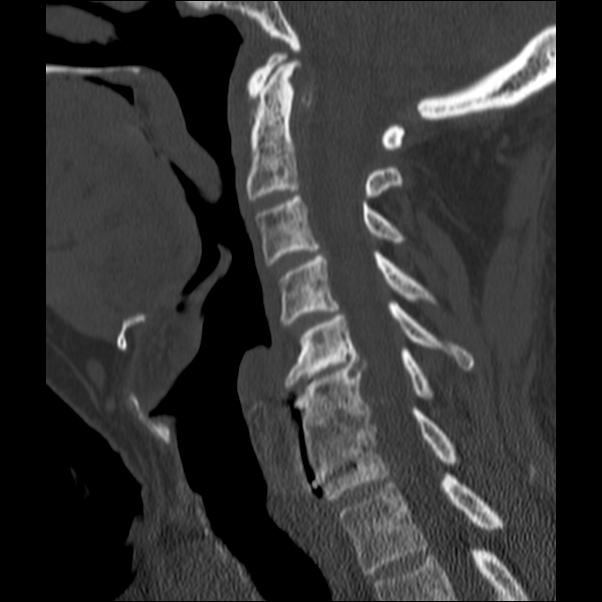 Anterior cervical postdiscectomy arthrodesis (Radiopaedia 32678-33646 Sagittal bone window 34).jpg