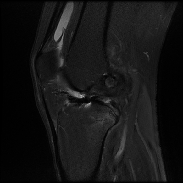 File:Anterior cruciate ligament graft tear and bucket-handle tear of medial meniscus (Radiopaedia 75867-87254 Sagittal PD fat sat 16).jpg
