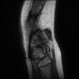 File:Anterior cruciate ligament tear - pediatric (Radiopaedia 62152-70260 Sagittal PD 154).jpg
