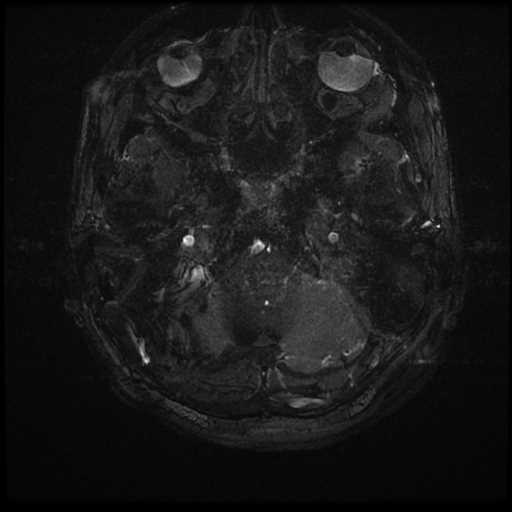 Anterior inferior cerebellar artery vascular loop - type II (Radiopaedia 70991-81209 Axial 3D FIESTA 81).jpg