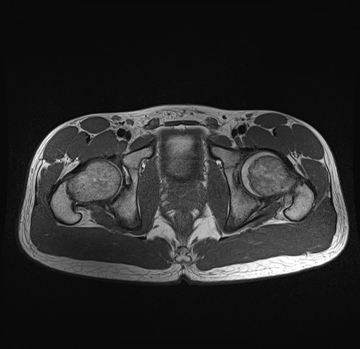 File:Anterior inferior iliac spine avulsion fracture (Radiopaedia 81312-95000 Axial T1 13).jpg