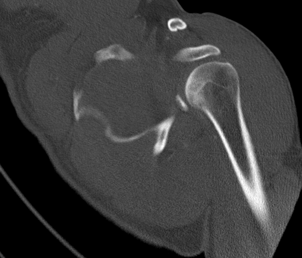 Anterior shoulder dislocation with Hill-Sachs and bony Bankart lesions (Radiopaedia 40424-42974 Coronal bone window 26).png
