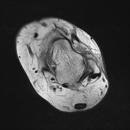 File:Anterior talofibular ligament injury - rupture with soft-tissue impingement (Radiopaedia 38765-40928 Axial PD 19).jpg