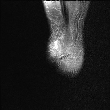 File:Anterior talofibular ligament injury - rupture with soft-tissue impingement (Radiopaedia 38765-40928 Sagittal PD fat sat 22).jpg