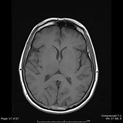 File:Anterior temporal lobe perivascular space (Radiopaedia 88283-104914 Axial T1 17).jpg