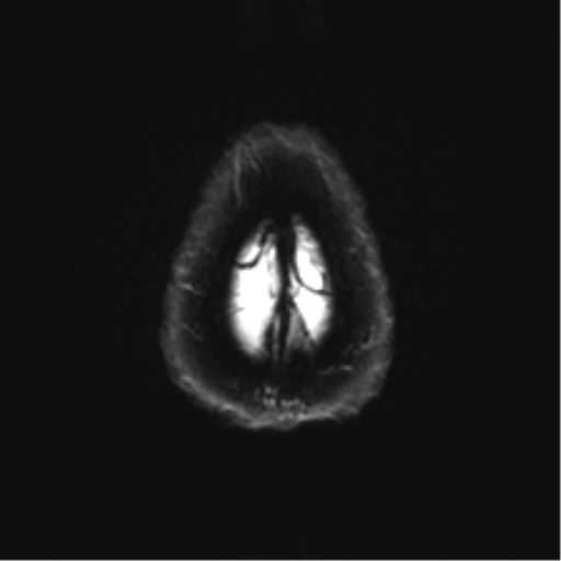 File:Anterior temporal pole cysts (Radiopaedia 46629-51102 Axial DWI 27).png