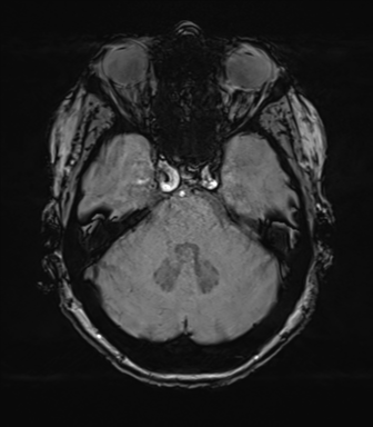 Anterior temporal pole cysts (Radiopaedia 46629-51102 Axial SWI 26).png