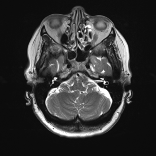 File:Anterior temporal pole cysts (Radiopaedia 46629-51102 C 9).png