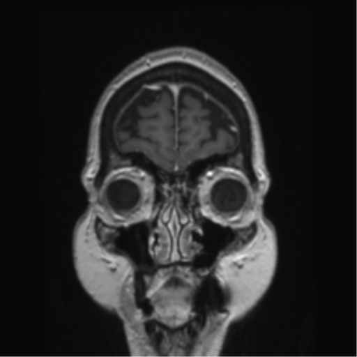 Anterior temporal pole cysts (Radiopaedia 46629-51102 Coronal T1 C+ 155).png