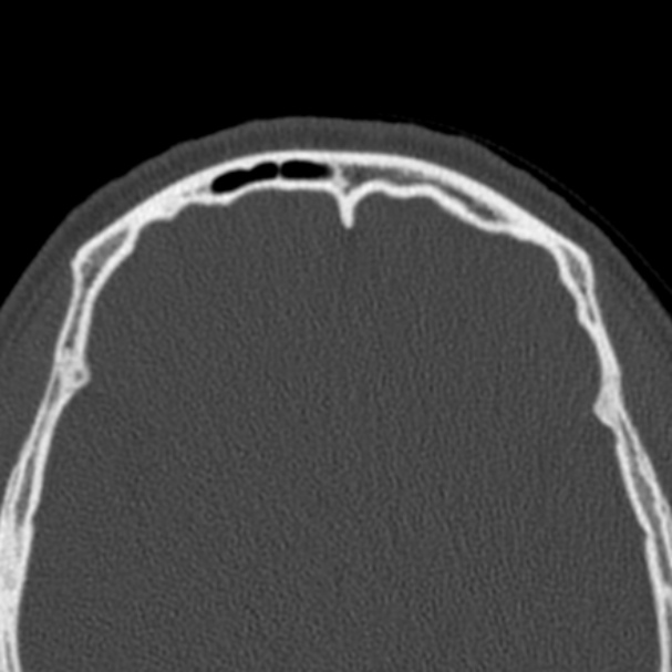 Antrochoanal polyp (Radiopaedia 33984-35202 Axial bone window 78).jpg