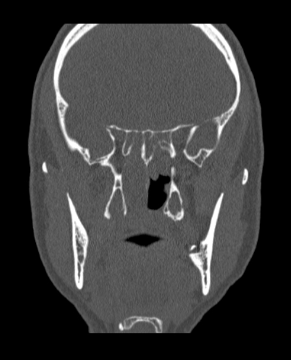 Antrochoanal polyp (Radiopaedia 79011-92169 Coronal bone window 29).jpg