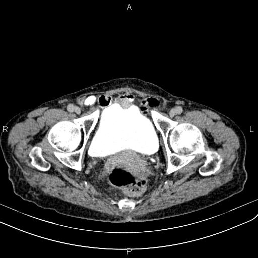 Aortic aneurysm and Lemmel syndrome (Radiopaedia 86499-102554 Axial C+ delayed 74).jpg