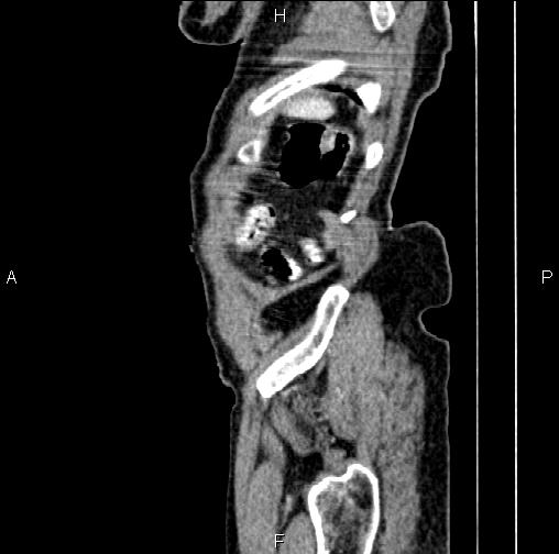 File:Aortic aneurysm and Lemmel syndrome (Radiopaedia 86499-102554 D 85).jpg