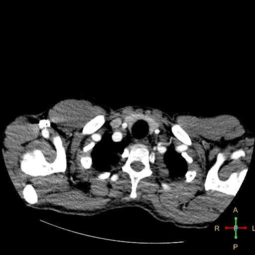 File:Aortic aneurysm and penetrating ulcer (Radiopaedia 23590-23704 A 1).jpg