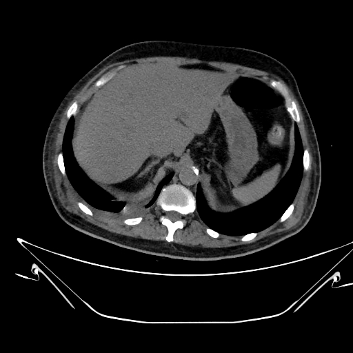 Aortic arch aneurysm (Radiopaedia 84109-99365 Axial non-contrast 265).jpg