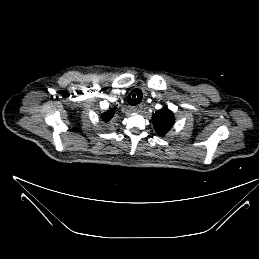 Aortic arch aneurysm (Radiopaedia 84109-99365 B 76).jpg