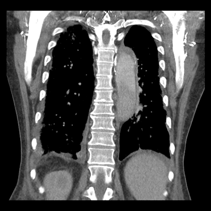 Aortic arch graft infection (FDG PET-CT) (Radiopaedia 71975-82437 Coronal 46).jpg