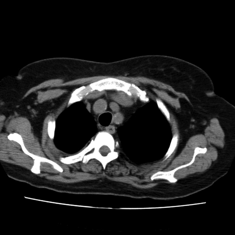 Aortic arch pseudoaneurysm (Radiopaedia 8534-9368 Axial non-contrast 10).jpg