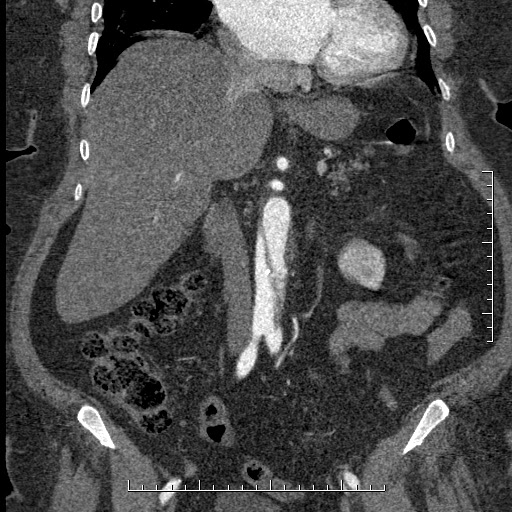 File:Aortic dissection- Stanford A (Radiopaedia 35729-37268 F 36).jpg