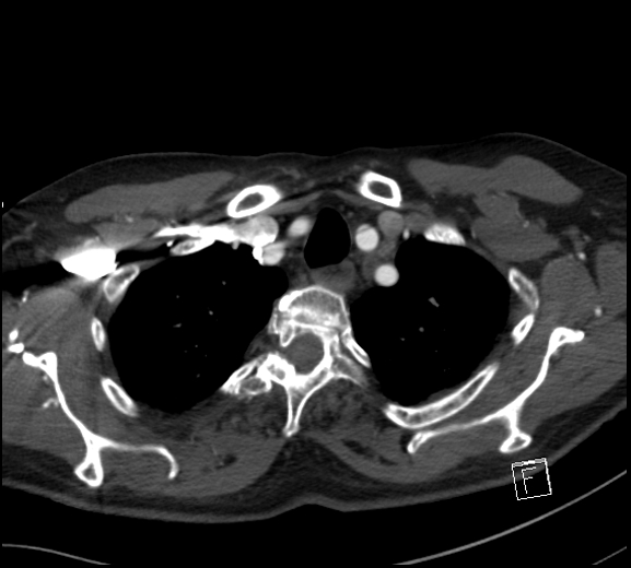 Aortic dissection (CTPA) (Radiopaedia 75506-86750 A 15).jpg