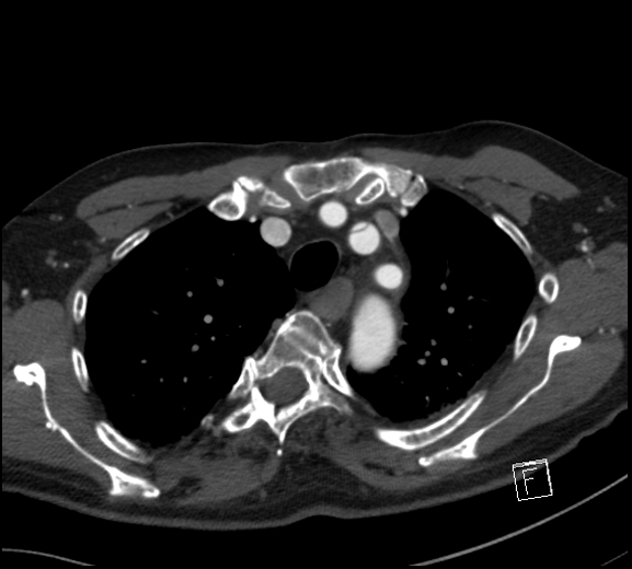 File:Aortic dissection (CTPA) (Radiopaedia 75506-86750 A 22).jpg