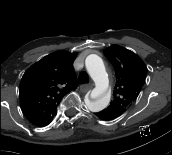 Aortic dissection (CTPA) (Radiopaedia 75506-86750 A 29).jpg