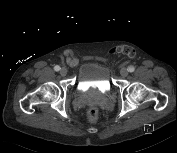 Aortic dissection (CTPA) (Radiopaedia 75506-86750 E 146).jpg