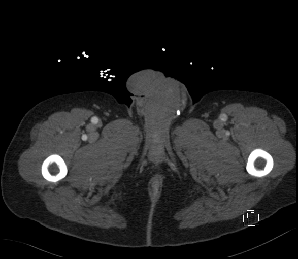 Aortic dissection (CTPA) (Radiopaedia 75506-86750 E 173).jpg