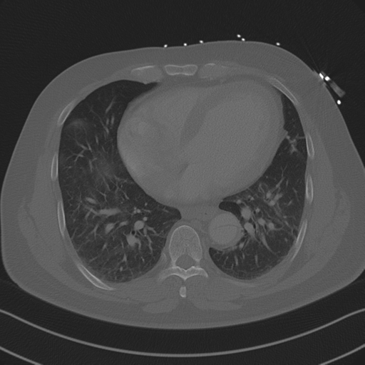 Aortic dissection (Radiopaedia 50763-56234 Axial bone window 68).png