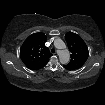 Aortic dissection (Radiopaedia 57969-64959 A 94).jpg