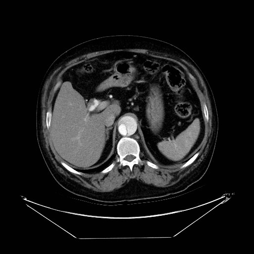 Aortic dissection (Radiopaedia 62562-71000 A 49).jpg