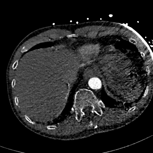 File:Aortic dissection - DeBakey type II (Radiopaedia 64302-73082 A 80).png
