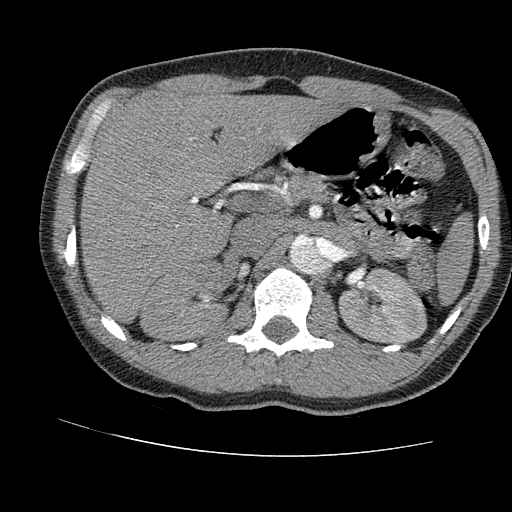 File:Aortic dissection - Stanford A -DeBakey I (Radiopaedia 28339-28587 B 118).jpg