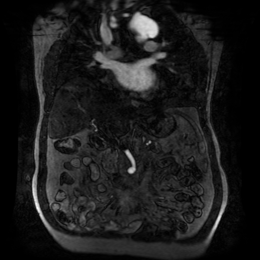Aortic dissection - Stanford A - DeBakey I (Radiopaedia 23469-23551 D 104).jpg