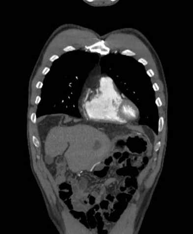 File:Aortic dissection - Stanford type B (Radiopaedia 73648-84437 B 27).jpg