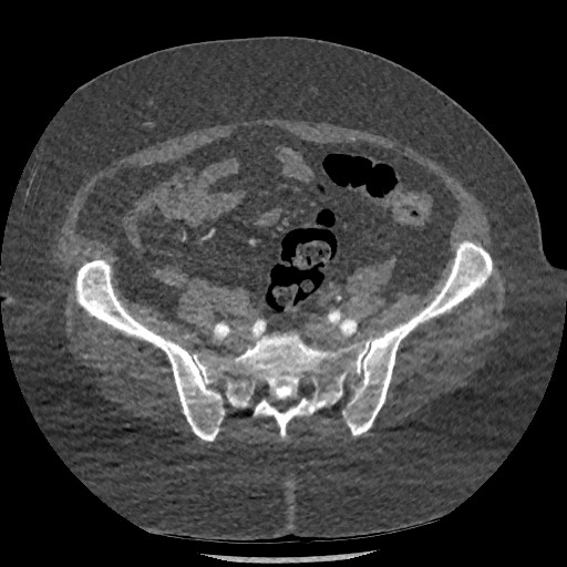 File:Aortic dissection - Stanford type B (Radiopaedia 88281-104910 A 141).jpg