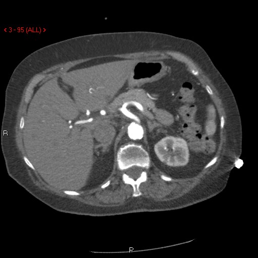 File:Aortic intramural hematoma (Radiopaedia 27746-28001 A 95).jpg